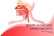 Nasopharngeal angiofibroma