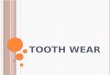Tooth wear and its types