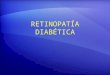 RETINOPATÍA DIABÉTICA. Retinopatía Diabética (RD) 1967: No prevención posible "Enfermedad relativamente no tratable" (Duke Elder) 1976: "DRS" La pérdida