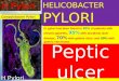 L8 peptic ulcer