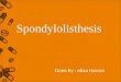 21 - Spondylolisthesis - D3