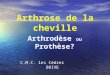 C.M.C. les Cédres BRIVE Arthrose de la cheville Arthrodèse ou Prothèse?
