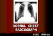 Normal Chest Radiograph ppt