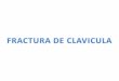 Fractura de Clavicula Tttt