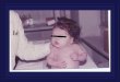 Segni e sintomi precoci di Ipotiroidismo congenito Ritardata emissione del meconio e/o stipsi Ittero neonatale protratto Distensione addominale e/o