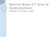 Normal brain ct scan & hydocephalus