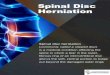 Spinal disc Herniation