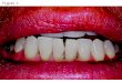 Restore Mandibular Anterior Teeth