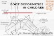 Foot deformities in children