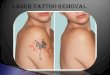 Laser Tattoo Removal Los Angeles | Tattoo Removal Los Angeles