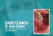 Caso Clínico "Implantes inmediatos postextracción de cordales superiores" - Dr. Enric Catalán