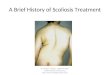 A Brief History of Scoliosis Treatment
