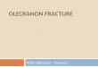 Olecranon fracture