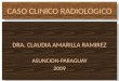 Caso Clínico Radiológico- Absceso pulmonar