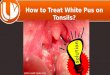 Solution: How to Treat White Pus on Tonsils?