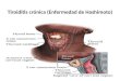 Tiroiditis crónica (Enfermedad de Hashimoto) jack