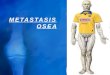 Metastasis Osea