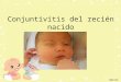 Conjuntivitis del recién nacido