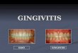 12 Gingivitis