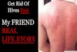 Get Rid Of Urticaria (Hives) Fast - My FRIEND REAL LIFE STORY