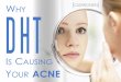 Why DHT is Causing Your Acne