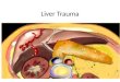 Liver trauma: A comprehensive review of classification, mechanisms, early management and surgical treatment