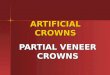 2. artificial crowns partial veneer crowns -midterm2