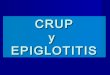 CRUP y epiglotitis