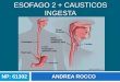 Esofago 2 + esofagitis cáustica