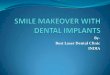 Smile makeover with dental implants in chennai