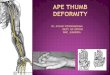 Ape thumb deformity to publish