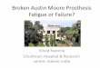 Broken austin moore prosthesis  fatigue or failure