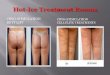 Cryo stimulation cellulite and butt lift treatments