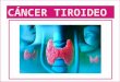 Cancer tiroides expo