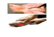 Plantar fasciitis symptoms, foot pain running, foot pain ball of foot, taping for plantar fasciitis