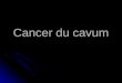Cancer du cavum