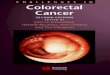 Challenges in colorectal cancer