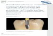 Super ﬁ cial roughness on composite surface, composite enamel and composite dentin junctions after different ﬁ nishing and polishing procedures. Part I: roughness after treatments