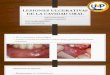 PATOLOGIA BUCAL I - Lesiones Ulcerativas