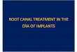 Root Canal Treatment in the Era of Implants