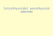Intrathyroidal Parathyroid Adenoma