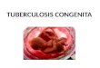 Tuberculosis Congenita