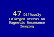 47 diffusely enlarged uterus on magnetic resonance imaging