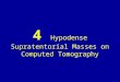 4 hypodense supratentorial masses on computed tomography