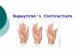 1 Dupuytren’s Contracture. 2  Fibrous tissue of the palmar fascia to shorten and thicken  Common in men older than 40 years; in persons of Northern