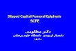 Slipped Capital Femoral Epiphysis SCFE دکتر مظلومی دانشیار ارتوپدی دانشگاه علوم پزشکی مشهد