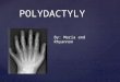{ POLYDACTYLY By: Maria and Rhyannon. Polydactyly is a Genetic disorder of the seventh chromosome which results in extra fingers or toes. Polydactyly