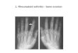 1. Rheumatoid arthritis - bone erosion. A and B, Radiographic features of aggressive, early rheumatoid arthritis