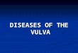 DISEASES OF THE VULVA. VULVA: NON-NEOPLASTIC EPITHELIAL DISORDERS There are two forms of NNED: There are two forms of NNED: lichen sclerosus lichen sclerosus