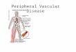 Peripheral Vascular Disease. Peripheral Artery Disease Peripheral Venous Disorders Carotid Artery Disease Peripheral Artery Disease Peripheral Renal Disease